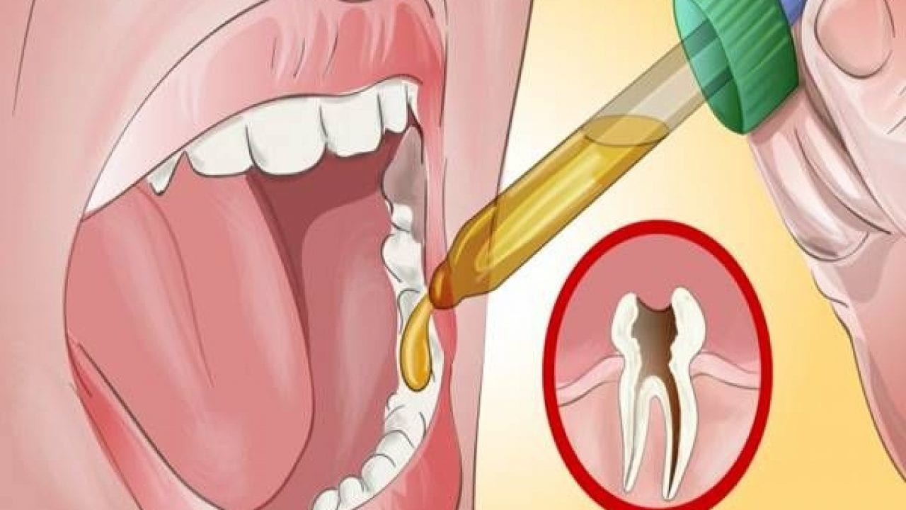 O que pingar no dente doendo? 